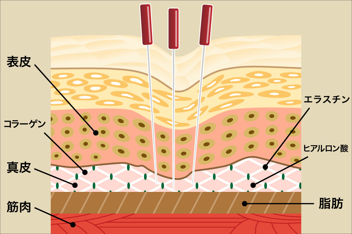 美容鍼の作用と効果
